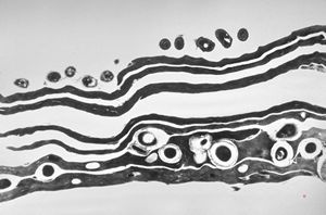 M,44y. | dermatomycosis (microbes superficially, fungi deeper) M,44y. | dermatomycosis (microbes superficially, fungi deeper)